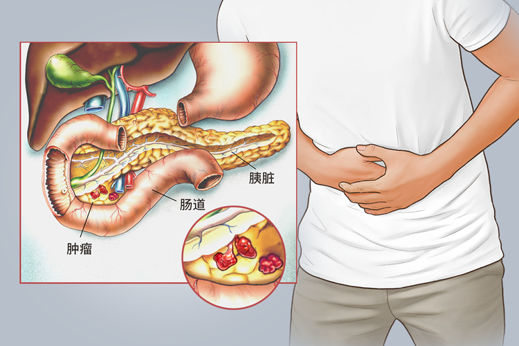 51岁男子每天大便两三次,确诊胰腺癌!6种异常或是身体“警报”